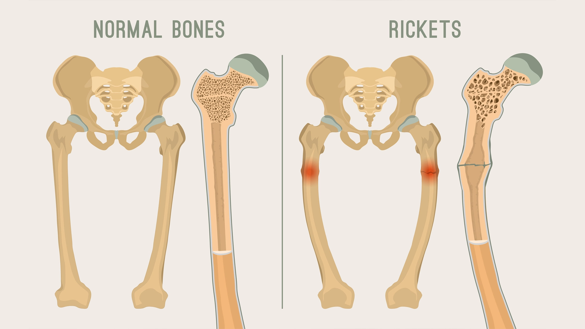 Understanding Rickets: Causes, Symptoms, and Treatment | Meri Sehat