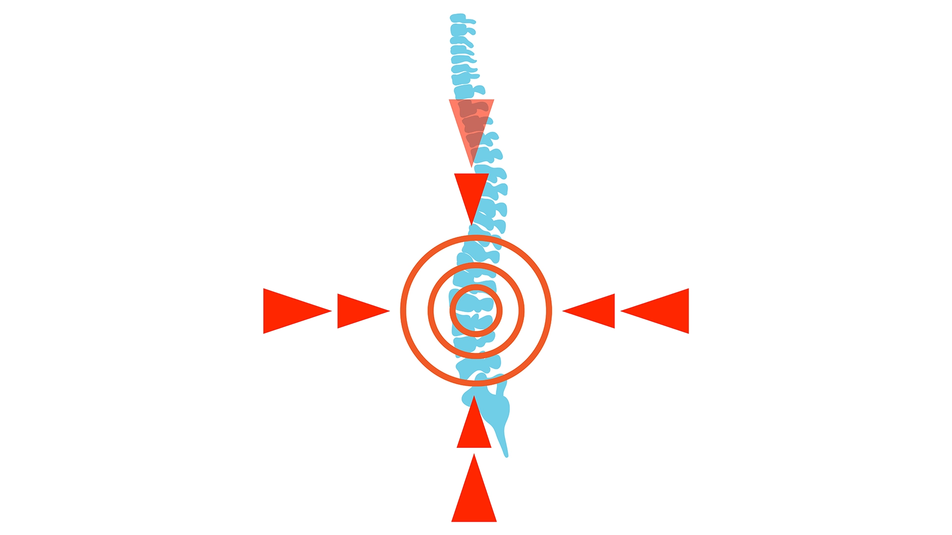 Herniated Disc Slipped Disc Bulging Disc Meri Sehat