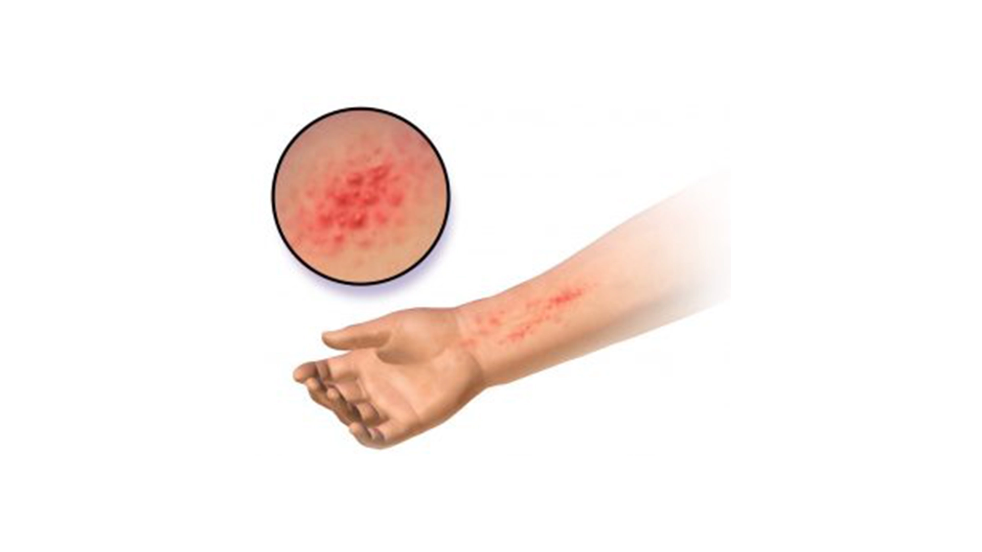 Gianotti-Crosti Syndrome: Symptoms, Causes, and Treatment | Meri Sehat