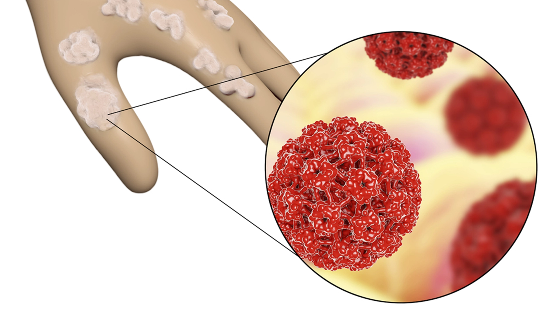 can you get hpv from sharing cigarettes Smoking Ups Risk: Exposure To Cigarette Smoke And Secondhand Smoke Increase A Person's Likelihood Of Contracting HPV Lowering Your Risk | Head