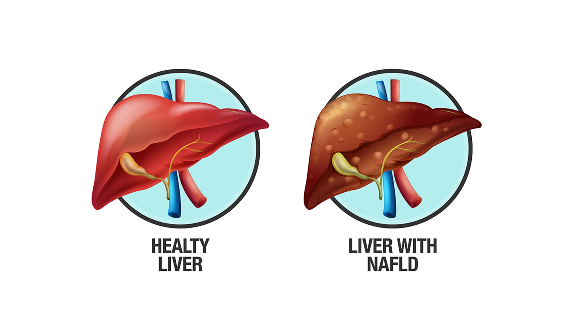 Non-Alcoholic Fatty Liver Disease (NAFLD): Causes, Symptoms, and Management  | Meri Sehat